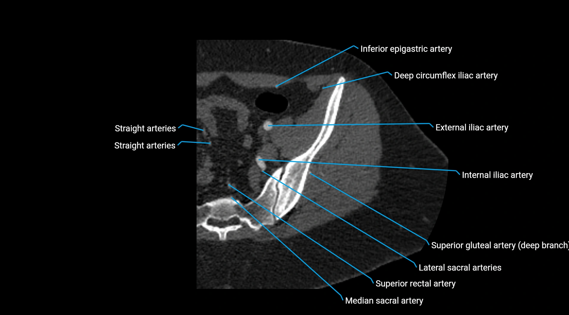 CTA lower limb cross sectional anatomy labelled image _29.webp